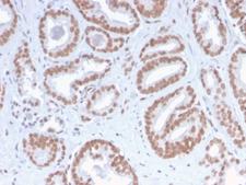 ATRX Antibody - Formalin-fixed, paraffin-embedded human Prostate Carcinoma stained with ATRX Rabbit Recombinant Monoclonal Antibody (ATRX/2900R).
