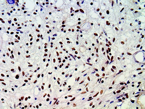 ATRX Antibody - IHC of ATRX on a FFPE Astrocytoma Tissue