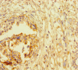 ATRX Antibody - Immunohistochemistry of paraffin-embedded human pancreatic cancer at dilution of 1:100