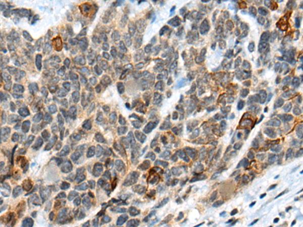 ATRX Antibody - Immunohistochemistry of paraffin-embedded Human thyroid cancer tissue  using ATRX Polyclonal Antibody at dilution of 1:50(×200)