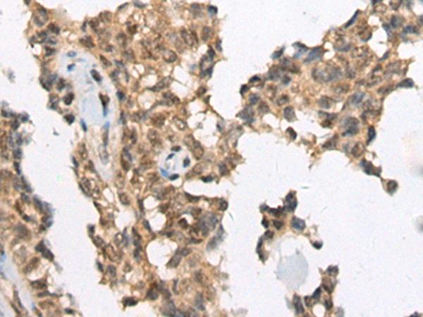 ATRX Antibody - Immunohistochemistry of paraffin-embedded Human ovarian cancer tissue  using ATRX Polyclonal Antibody at dilution of 1:50(×200)