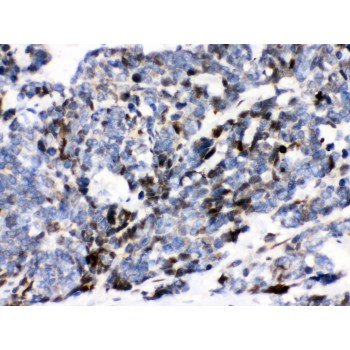ATXN1 / SCA1 Antibody - Ataxin 1 antibody IHC-paraffin. IHC(P): Human Lung Cancer Tissue.