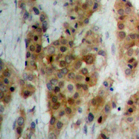 ATXN1 / SCA1 Antibody - Immunohistochemical analysis of Ataxin 1 staining in human breast cancer formalin fixed paraffin embedded tissue section. The section was pre-treated using heat mediated antigen retrieval with sodium citrate buffer (pH 6.0). The section was then incubated with the antibody at room temperature and detected using an HRP conjugated compact polymer system. DAB was used as the chromogen. The section was then counterstained with hematoxylin and mounted with DPX.