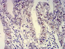 ATXN1 / SCA1 Antibody - Immunohistochemical analysis of paraffin-embedded endometrial cancer tissues using ATXN1 mouse mAb with DAB staining.
