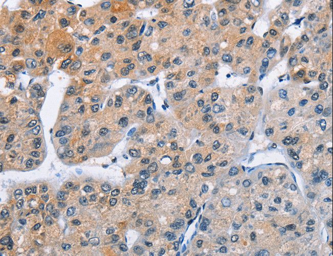 ATXN1 / SCA1 Antibody - Immunohistochemistry of paraffin-embedded Human liver cancer using ATXN1 Polyclonal Antibody at dilution of 1:40.