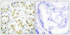 ATXN1 / SCA1 Antibody - Peptide - + Immunohistochemistry analysis of paraffin-embedded human lung carcinoma tissue using Ataxin 1 antibody.