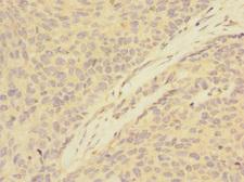 ATXN10 / SCA10 Antibody - Immunohistochemistry of paraffin-embedded human ovarian cancer at dilution 1:100