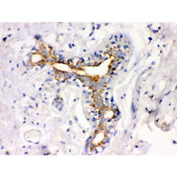 ATXN2 / SCA2 / Ataxin-2 Antibody - ATX2 antibody IHC-paraffin. IHC(P): Human Mammary Cancer Tissue.