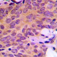 ATXN2 / SCA2 / Ataxin-2 Antibody - Immunohistochemical analysis of Ataxin 2 staining in human breast cancer formalin fixed paraffin embedded tissue section. The section was pre-treated using heat mediated antigen retrieval with sodium citrate buffer (pH 6.0). The section was then incubated with the antibody at room temperature and detected using an HRP conjugated compact polymer system. DAB was used as the chromogen. The section was then counterstained with hematoxylin and mounted with DPX.