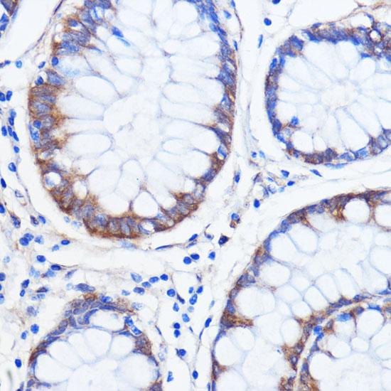 ATXN2 / SCA2 / Ataxin-2 Antibody - Immunohistochemistry of paraffin-embedded Human colon carcinoma using ATXN2 Polyclonal Antibody at dilution of 1:100 (40x lens).