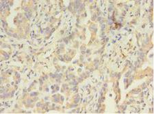 ATXN3 / JOS Antibody - Immunohistochemistry of paraffin-embedded human lung cancer using antibody at 1:100 dilution.  This image was taken for the unconjugated form of this product. Other forms have not been tested.