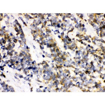 ATXN3 / JOS Antibody - Ataxin 3 antibody IHC-paraffin. IHC(P): Human Lung Cancer Tissue.