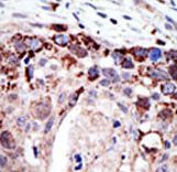ATXN3 / JOS Antibody - Formalin-fixed and paraffin-embedded human cancer tissue reacted with the primary antibody, which was peroxidase-conjugated to the secondary antibody, followed by AEC staining. This data demonstrates the use of this antibody for immunohistochemistry; clinical relevance has not been evaluated. BC = breast carcinoma; HC = hepatocarcinoma.