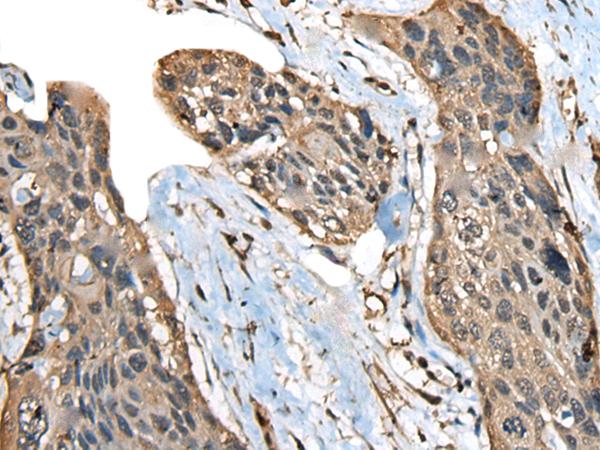 ATXN3 / JOS Antibody - Immunohistochemistry of paraffin-embedded Human esophagus cancer tissue  using ATXN3 Polyclonal Antibody at dilution of 1:100(×200)