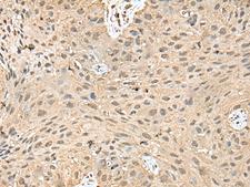 ATXN3 / JOS Antibody - Immunohistochemistry of paraffin-embedded Human lung cancer tissue  using ATXN3 Polyclonal Antibody at dilution of 1:50(×200)