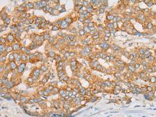 ATXN7 / SCA7 / Ataxin-7 Antibody - Immunohistochemistry of paraffin-embedded Human liver cancer tissue  using ATXN7 Polyclonal Antibody at dilution of 1:60(×200)
