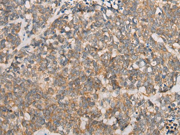 ATXN7 / SCA7 / Ataxin-7 Antibody - Immunohistochemistry of paraffin-embedded Human lung cancer tissue  using ATXN7 Polyclonal Antibody at dilution of 1:60(×200)