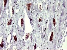 ATXN7L1 Antibody - IHC of paraffin-embedded Adenocarcinoma of Human breast tissue using anti-ATXN7L1 mouse monoclonal antibody. (Heat-induced epitope retrieval by 10mM citric buffer, pH6.0, 120°C for 3min).