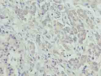 ATXN7L1 Antibody - Immunohistochemistry of paraffin-embedded human pancreatic cancer using antibody at dilution of 1:100.