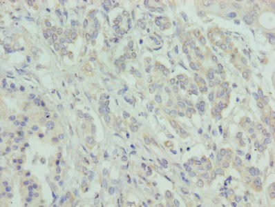 ATXN7L1 Antibody - Immunohistochemistry of paraffin-embedded human pancreatic cancer using ATXN7L1 Antibody at dilution of 1:100