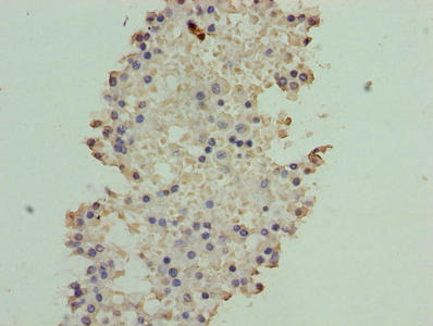 ATXN7L1 Antibody - Immunohistochemistry of paraffin-embedded human breast cancer using ATXN7L1 Antibody at dilution of 1:100