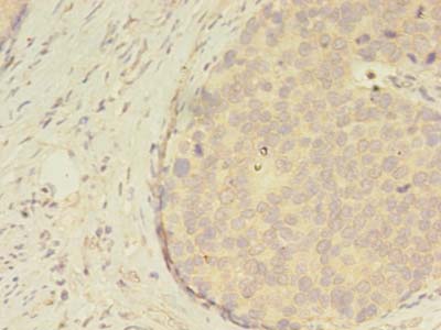ATXN7L3 Antibody - Immunohistochemistry of paraffin-embedded human gastric cancer using antibody at dilution of 1:100.