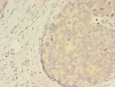 ATXN7L3 Antibody - Immunohistochemistry of paraffin-embedded human gastric cancer using antibody at dilution of 1:100.