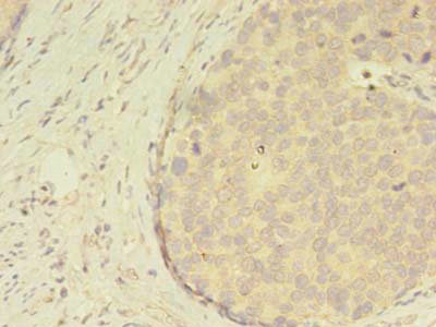 ATXN7L3 Antibody - Immunohistochemistry of paraffin-embedded human gastric cancer using ATXN7L3 Antibody at dilution of 1:100