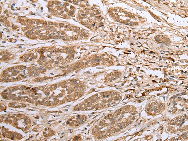 ATXN7L3 Antibody - Immunohistochemistry of paraffin-embedded Human esophagus cancer tissue  using ATXN7L3 Polyclonal Antibody at dilution of 1:40(×200)