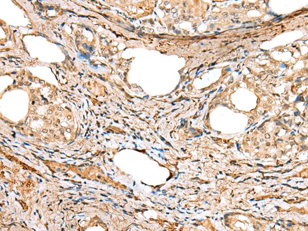 ATXN7L3 Antibody - Immunohistochemistry of paraffin-embedded Human thyroid cancer tissue  using ATXN7L3 Polyclonal Antibody at dilution of 1:40(×200)