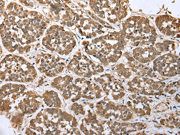 ATXN7L3 Antibody - Immunohistochemistry of paraffin-embedded Human esophagus cancer tissue  using ATXN7L3 Polyclonal Antibody at dilution of 1:35(×200)