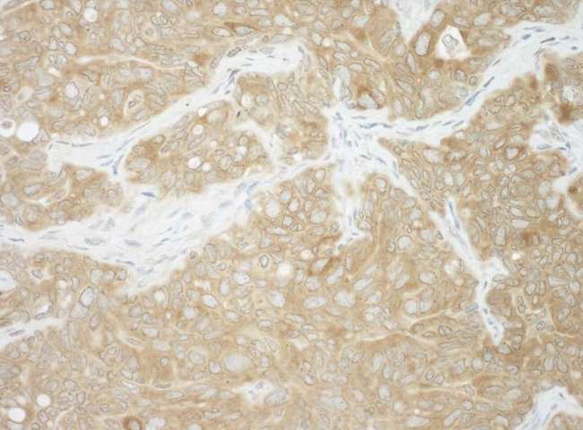 AUP1 Antibody - Detection of Human AUP1 by Immunohistochemistry. Sample: FFPE section of human ovarian carcinoma. Antibody: Affinity purified rabbit anti-AUP1 used at a dilution of 1:1000 (1 Detection: DAB.
