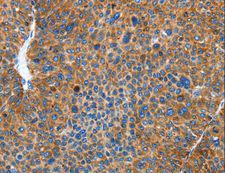 AUP1 Antibody - Immunohistochemistry of paraffin-embedded Human liver cancer using AUP1 Polyclonal Antibody at dilution of 1:50.