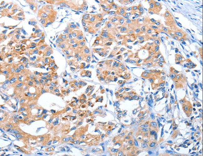 AUP1 Antibody - Immunohistochemistry of paraffin-embedded Human lung cancer using AUP1 Polyclonal Antibody at dilution of 1:50.