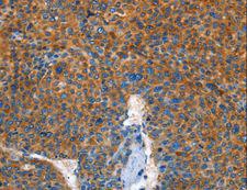 AUP1 Antibody - Immunohistochemistry of paraffin-embedded Human liver cancer using AUP1 Polyclonal Antibody at dilution of 1:50.