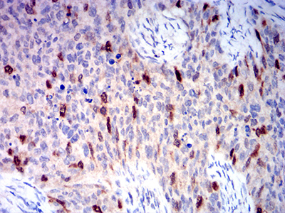AURKA / Aurora-A Antibody - Immunohistochemical analysis of paraffin-embedded cervical cancer tissues using AURKA mouse mAb with DAB staining.