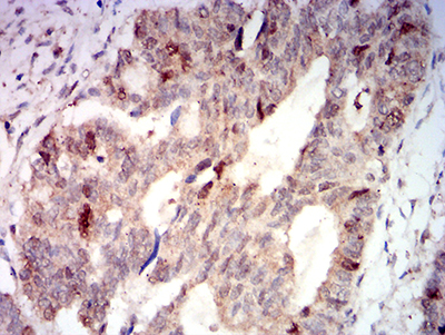 AURKA / Aurora-A Antibody - Immunohistochemical analysis of paraffin-embedded rectum cancer tissues using AURKA mouse mAb with DAB staining.