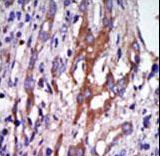 AURKA / Aurora-A Antibody - Formalin-fixed and paraffin-embedded human cancer tissue reacted with the primary antibody, which was peroxidase-conjugated to the secondary antibody, followed by DAB staining. This data demonstrates the use of this antibody for immunohistochemistry; clinical relevance has not been evaluated. BC = breast carcinoma; HC = hepatocarcinoma.