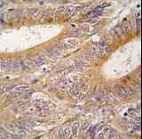 AURKA / Aurora-A Antibody - Formalin-fixed and paraffin-embedded human colon carcinoma tissue reacted with AIK antibody , which was peroxidase-conjugated to the secondary antibody, followed by DAB staining. This data demonstrates the use of this antibody for immunohistochemistry; clinical relevance has not been evaluated.