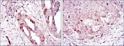 AURKA / Aurora-A Antibody - IHC of paraffin-embedded ovarian cancer (left) and lung cancer (right) using AURKA mouse monoclonal antibody with DAB staining.