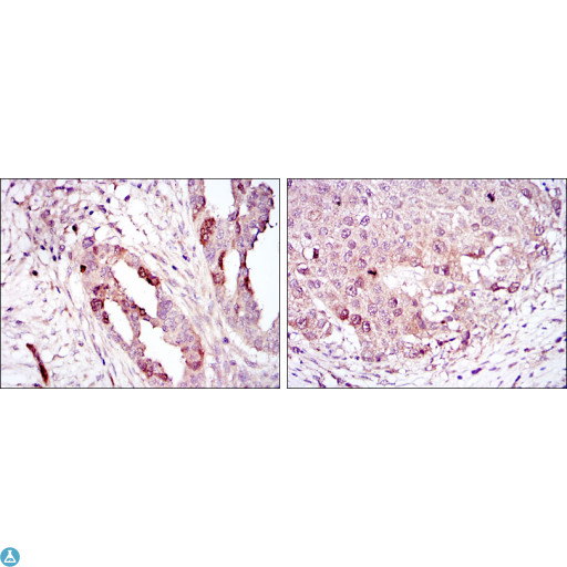 AURKA / Aurora-A Antibody - Immunohistochemistry (IHC) analysis of paraffin-embedded ovarian cancer (left) and lung cancer (right) with DAB staining using ARK-1 Monoclonal Antibody.