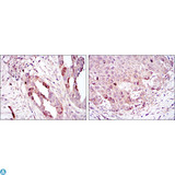 AURKA / Aurora-A Antibody - Immunohistochemistry (IHC) analysis of paraffin-embedded ovarian cancer (left) and lung cancer (right) with DAB staining using ARK-1 Monoclonal Antibody.