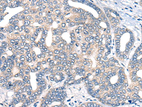 AURKA / Aurora-A Antibody - Immunohistochemistry of paraffin-embedded Human liver cancer tissue  using AURKA Polyclonal Antibody at dilution of 1:40(×200)