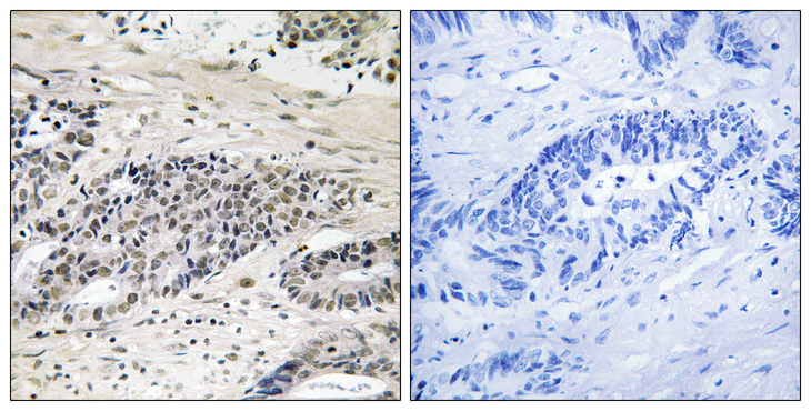 AURKA / Aurora-A Antibody - Immunohistochemistry analysis of paraffin-embedded human colon carcinoma, using AurA (Phospho-Ser342) Antibody. The picture on the right is blocked with the phospho peptide.
