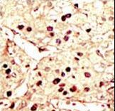 AURKB / Aurora-B Antibody - Formalin-fixed and paraffin-embedded human cancer tissue reacted with the primary antibody, which was peroxidase-conjugated to the secondary antibody, followed by DAB staining. This data demonstrates the use of this antibody for immunohistochemistry; clinical relevance has not been evaluated. BC = breast carcinoma; HC = hepatocarcinoma.