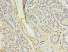 AURKB / Aurora-B Antibody - Immunohistochemistry of paraffin-embedded human breast cancer using antibody at 1:100 dilution.  This image was taken for the unconjugated form of this product. Other forms have not been tested.