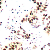 AURKB / Aurora-B Antibody - Immunohistochemical analysis of Aurora B staining in human breast cancer formalin fixed paraffin embedded tissue section. The section was pre-treated using heat mediated antigen retrieval with sodium citrate buffer (pH 6.0). The section was then incubated with the antibody at room temperature and detected using an HRP conjugated compact polymer system. DAB was used as the chromogen. The section was then counterstained with hematoxylin and mounted with DPX.