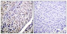 AURKB / Aurora-B Antibody - Peptide - + Immunohistochemistry analysis of paraffin-embedded human liver carcinoma tissue using AurB (Ab-12) antibody.