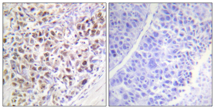 AURKB / Aurora-B Antibody - Immunohistochemistry analysis of paraffin-embedded human liver carcinoma, using AurB (Phospho-Thr232) Antibody. The picture on the right is blocked with the phospho peptide.