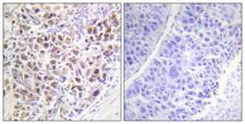 AURKB / Aurora-B Antibody - Immunohistochemistry analysis of paraffin-embedded human liver carcinoma, using AurB (Phospho-Thr232) Antibody. The picture on the right is blocked with the phospho peptide.